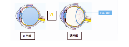 眼病|28岁女子双眼突然看不见，原来是这个“病”！