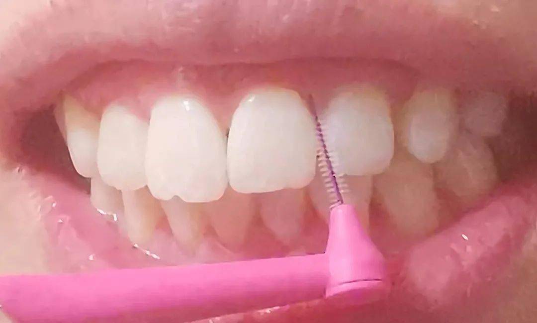 (图片由医生提供)使用牙缝刷时,许多人只是水平刷牙缝,不敢深入牙周袋