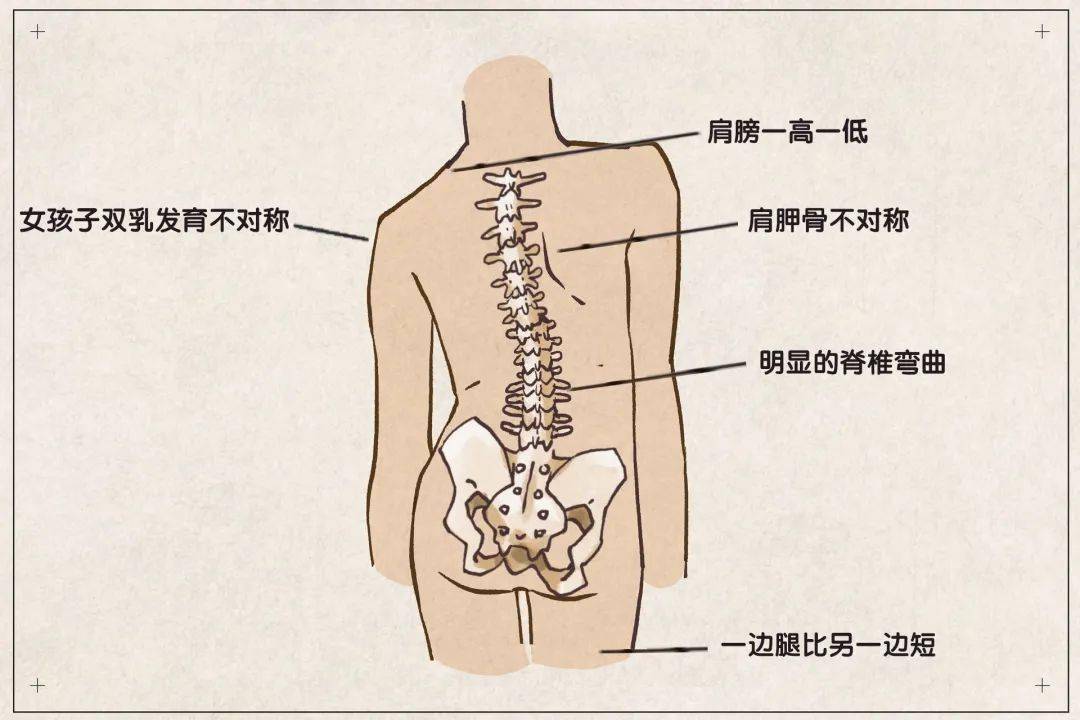 女生背部脊柱突出图片图片