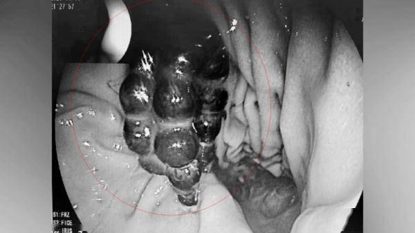 家长|4岁男童出现咳嗽、发烧症状，结果胃里取出34颗磁力珠……