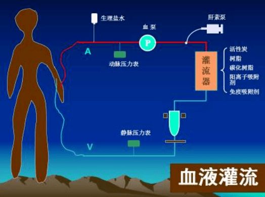治疗|血液灌流,过敏性紫癜患儿的新选择