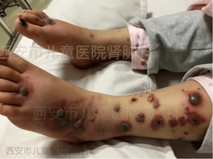 治疗|血液灌流，过敏性紫癜患儿的新选择