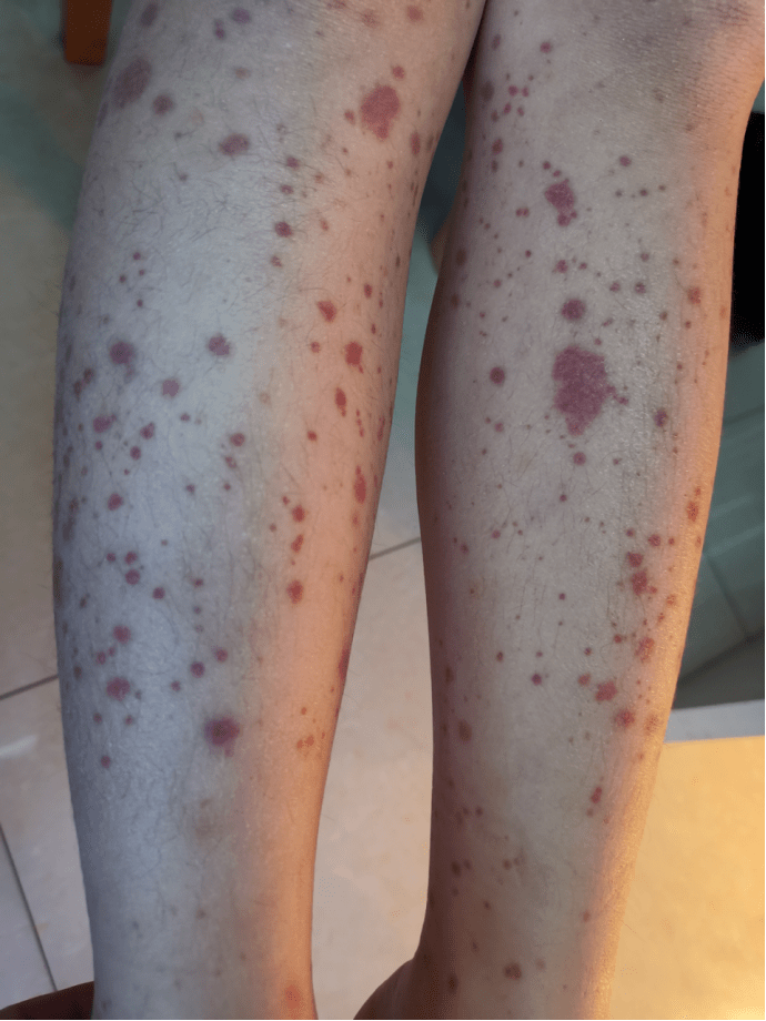 儿童过敏性紫癜出血点图片