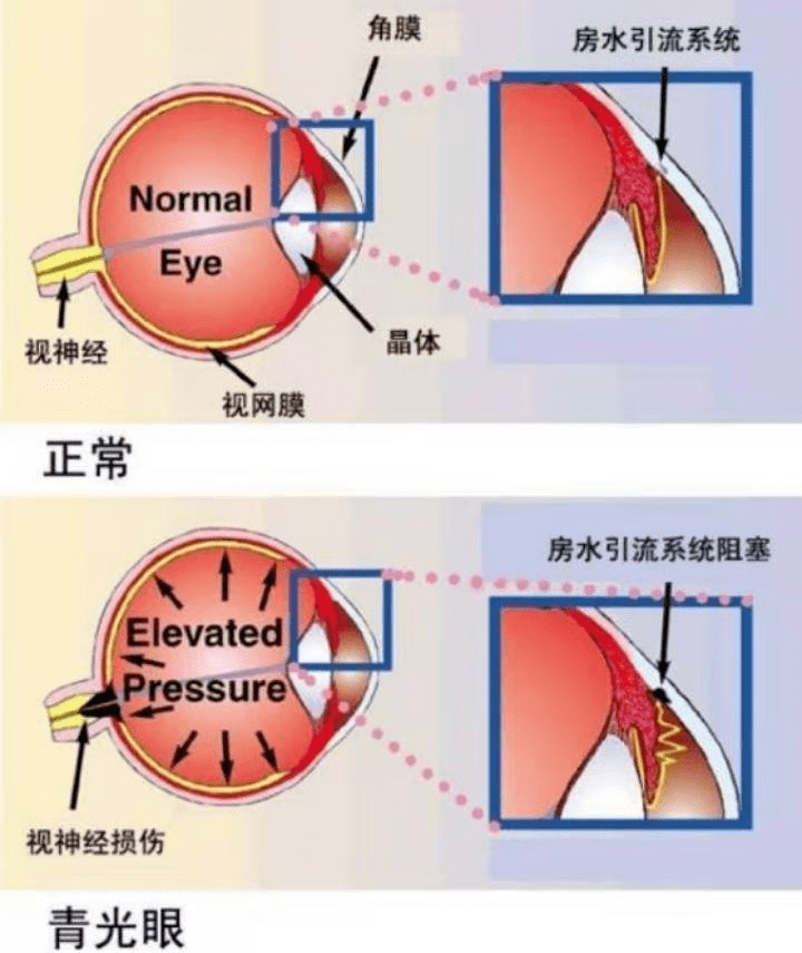 因此,控制眼压是治疗青光眼的关键,而保证眼内房水正常循环就和眼压