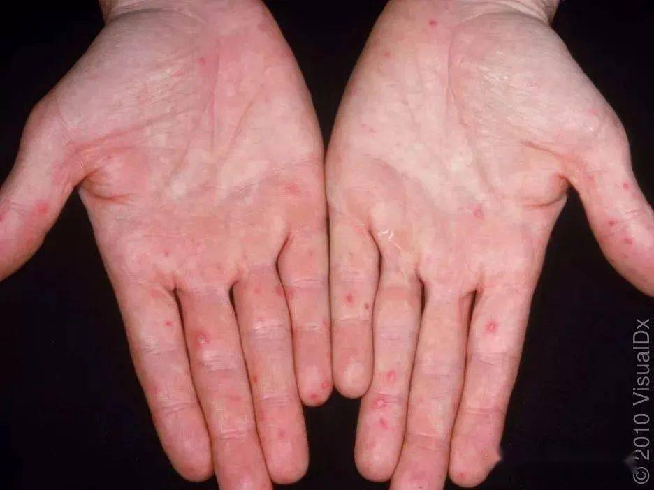 手足口病 可防可控不可怕