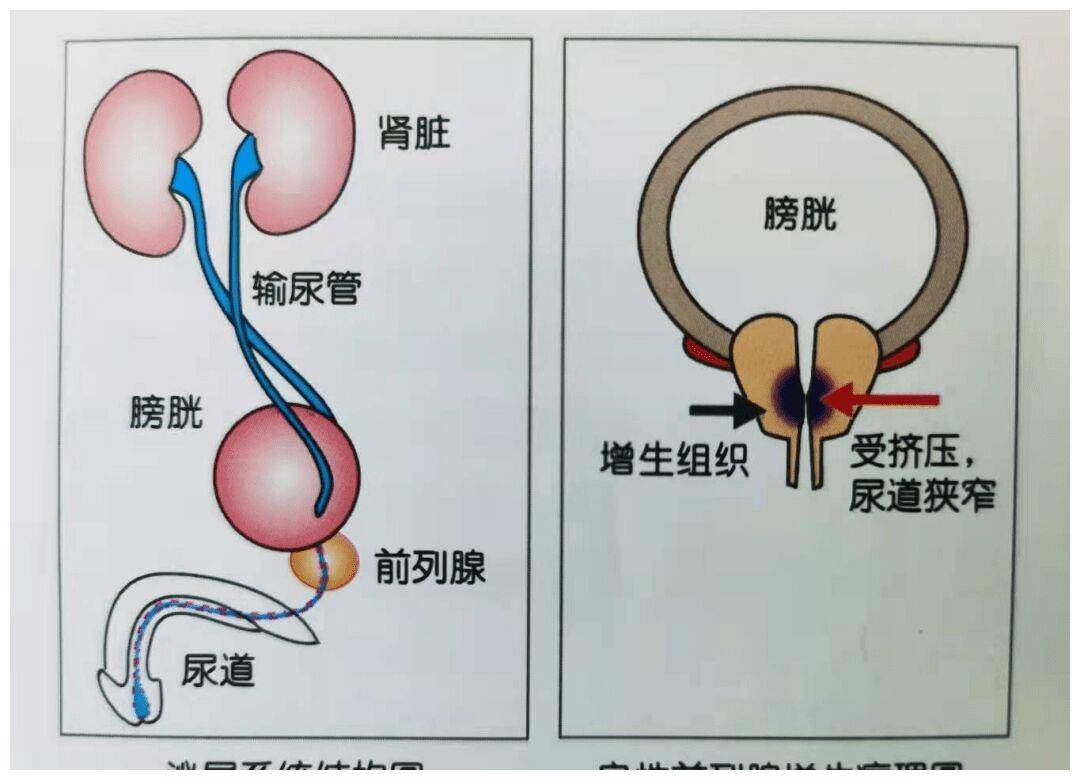 前列腺增生为什么不容小觑?_膀胱