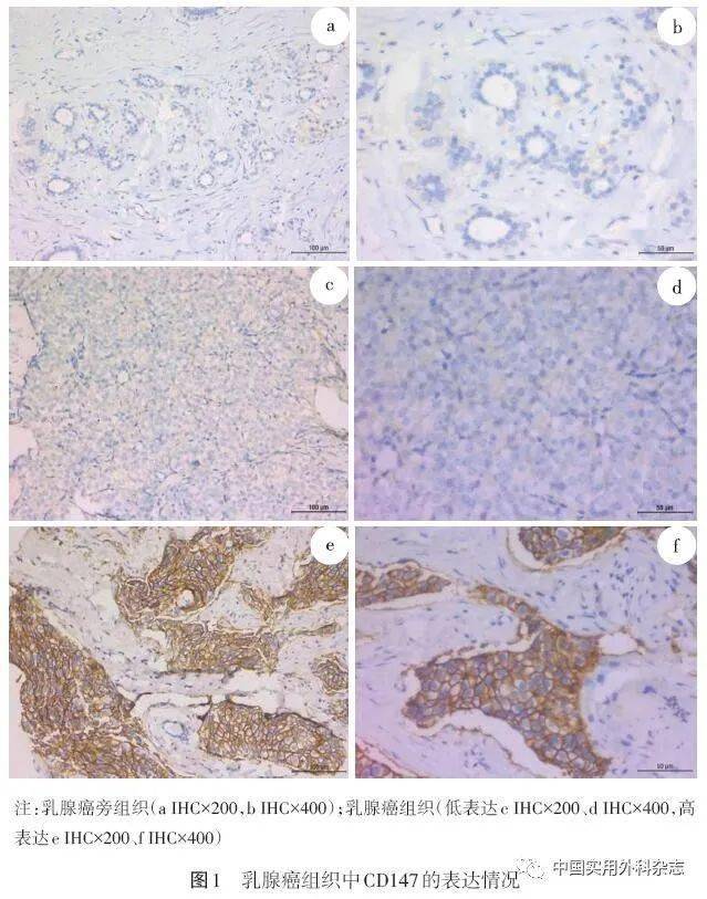 論著乳腺浸潤性導管癌中cd147表達及其對預後影響分析