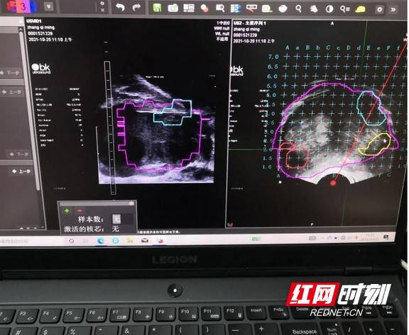 湖南省肿瘤医院开展磁共振超声影像融合前列腺穿刺活检术