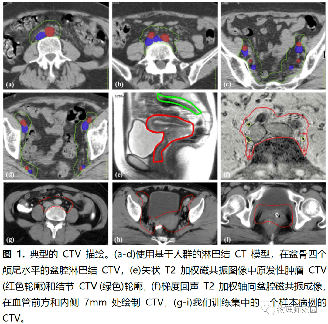 宫颈癌放射治疗中自动勾画临床靶体积和危及器官的深度学习算法的开发