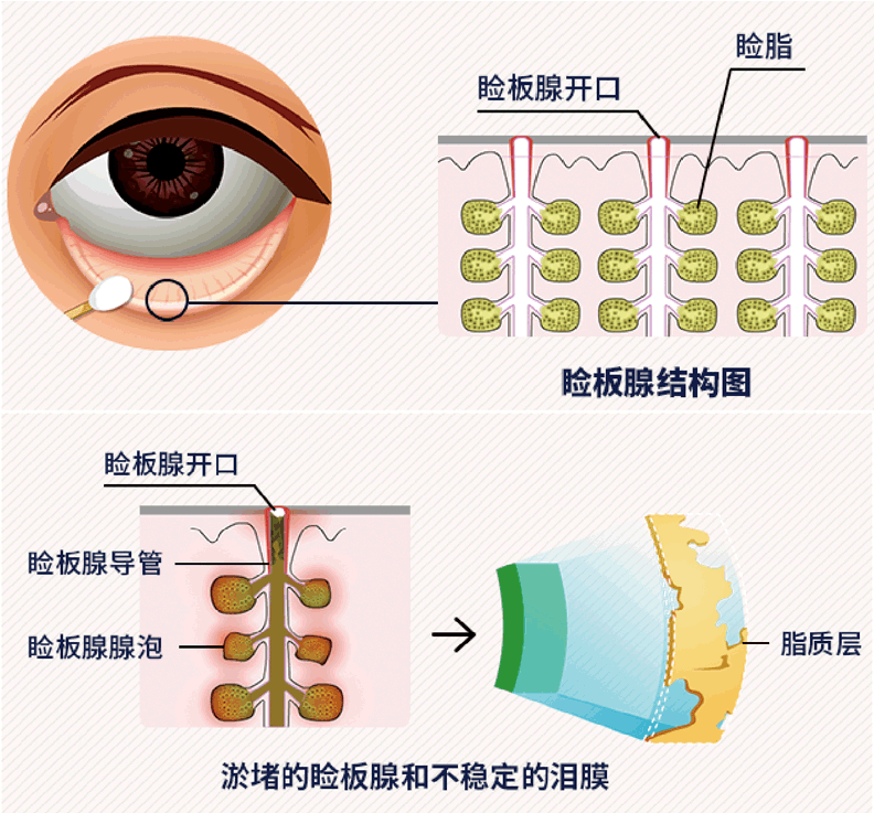 上下眼睑中有一层致密有弹性的组织叫做睑板,睑板内有垂直排列的腺体