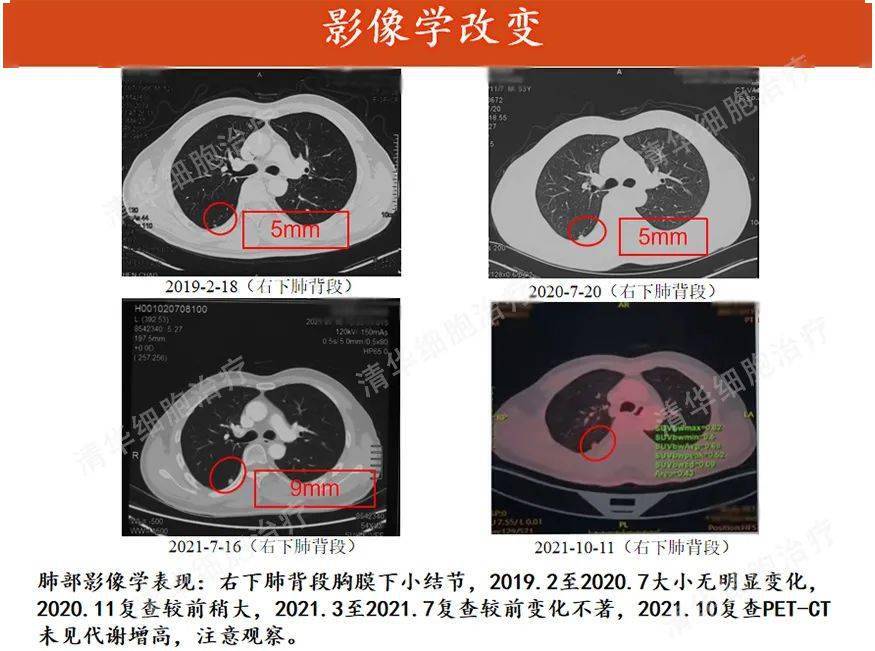 不願在家坐等第三次轉移,腎癌的他這樣選擇