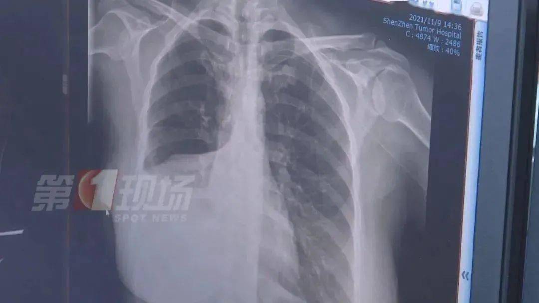 肿瘤|一女子手指肿成“萝卜头”，一查竟是癌症！务必警惕身体这些信号