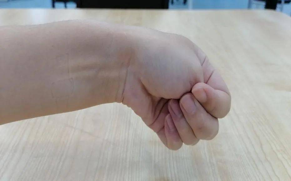 桡骨茎突腱鞘炎试验:患手握拳,拇指屈于掌内,腕尺偏,若在桡骨茎突处