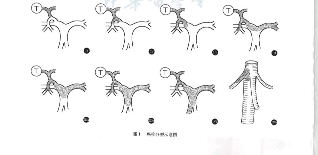 原發性肝癌合併門靜脈癌栓,放療的地位和現狀—抗癌管家