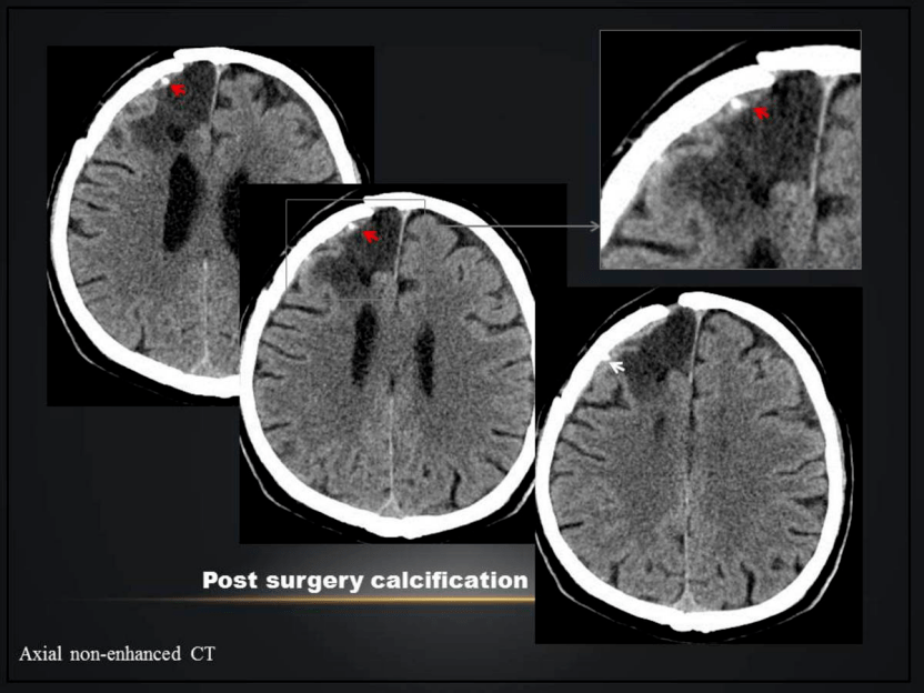 侧脑室脉络丛钙化图片