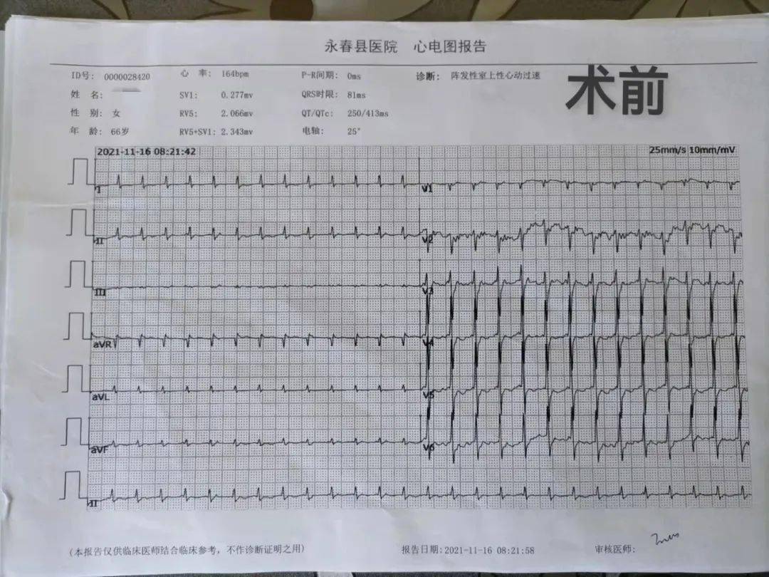 患者蔡xx,女,66岁,以"反复发作胸闷,心悸"为主诉入院,经查心电图后