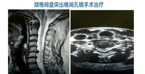 您知道什么是颈椎间盘突出症吗?_治疗_症状_脊神经