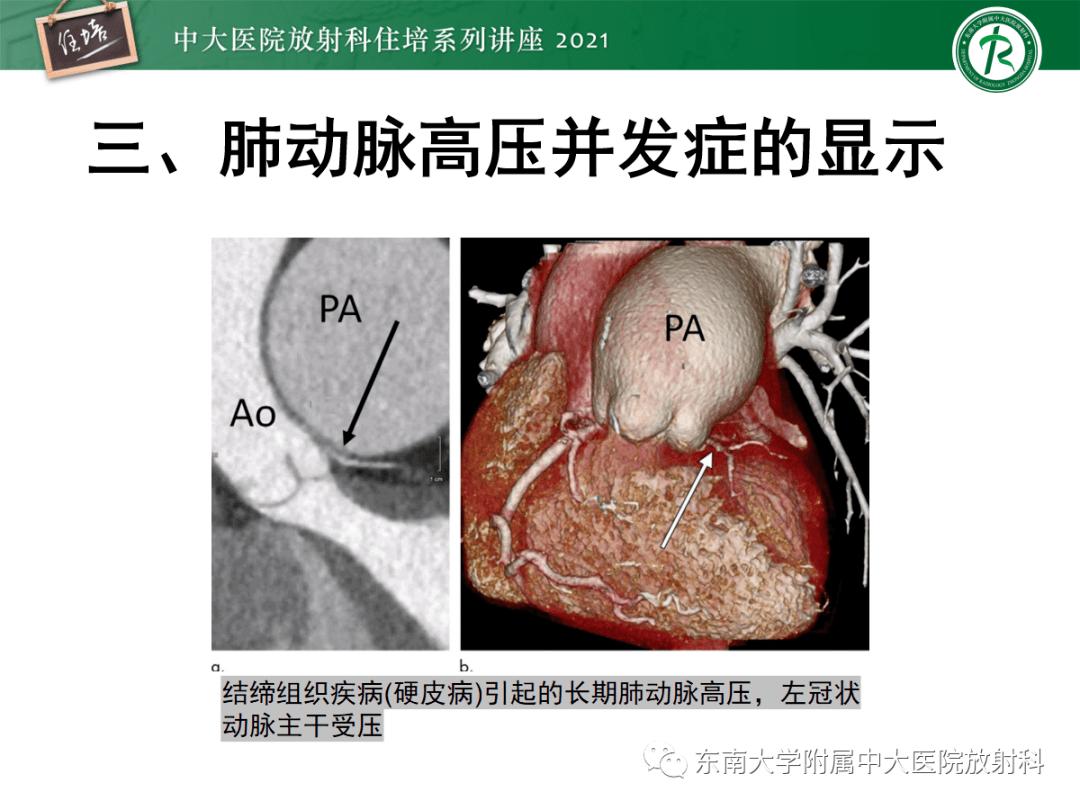 肺动脉段平直图片