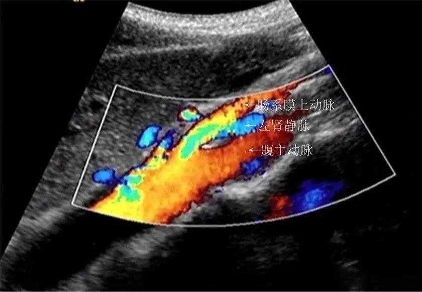 胡桃夹综合征超声检查胡桃夹综合征的诊断包含病史,体格检查及辅助