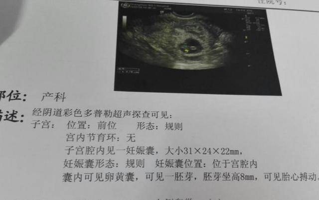 怀孕b超单图片 胎儿图片