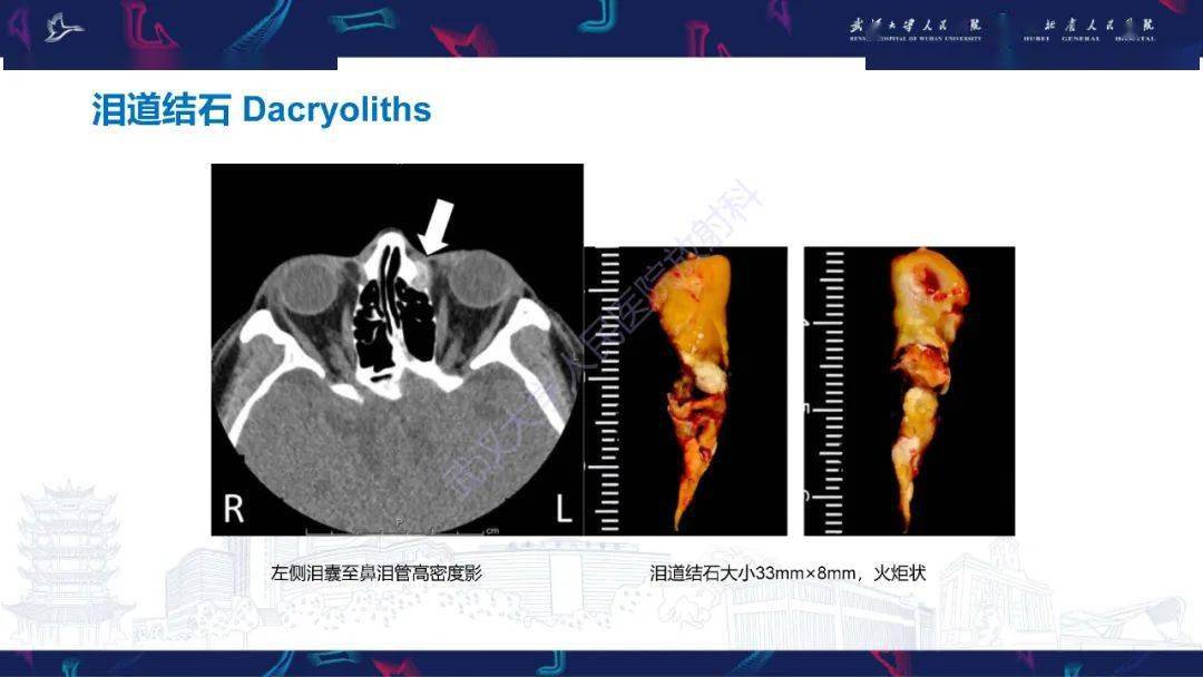 泪腺解剖ct图片