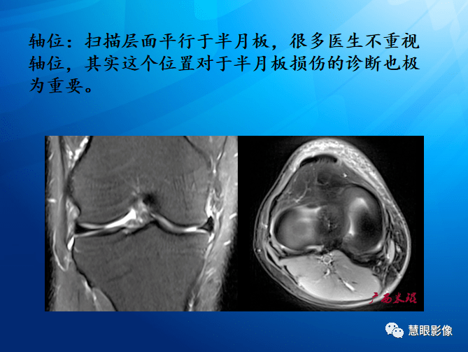 mri半月板損傷基礎