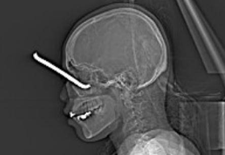 手术|吓人！广西一女子被13cm钢筋扎入眼眶，眼鼻鲜血直流……