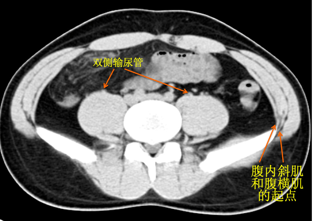 raus專欄|經腰手術體表標誌05_定位_解剖_最高點