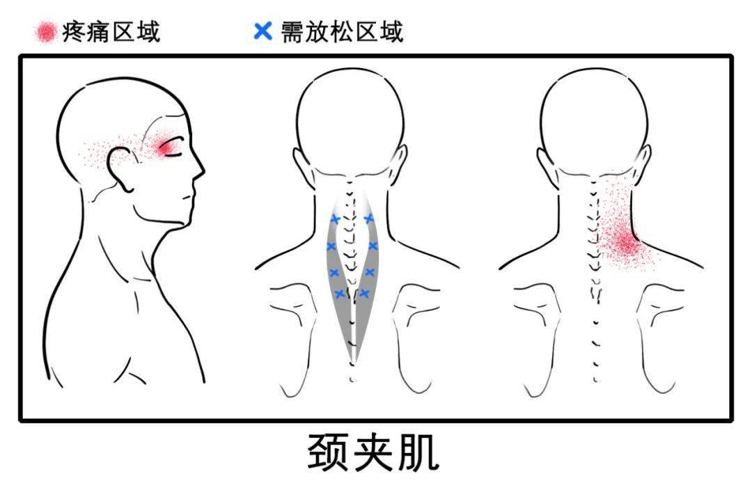 头颈夹肌锻炼方法图片