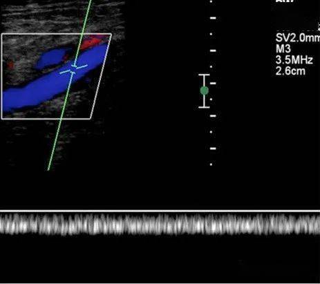 血管超声基础61静脉频谱的期相性