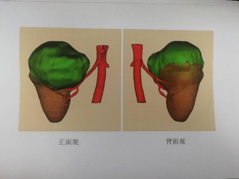 技术|肾脏肿瘤六年胀大三倍多，广州专家“组合拳”成功切瘤保肾