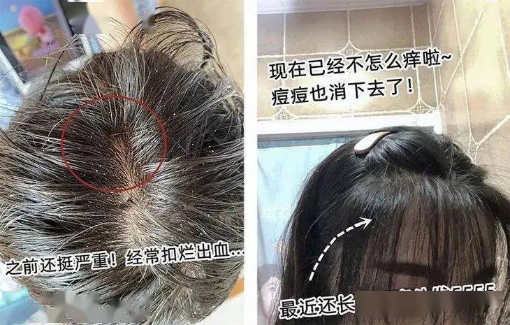 头皮头发总掉竟是「发根」缺了它！简单一招，5天生新发！发量重回18岁