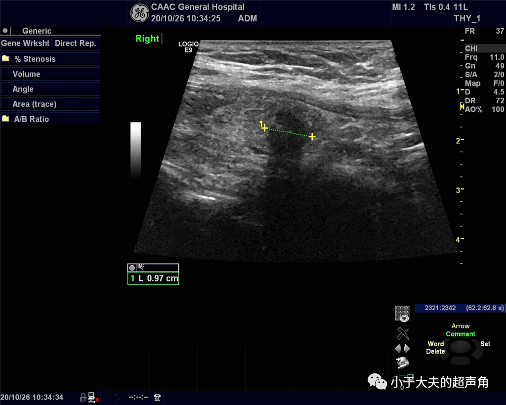 再问:『这甲状腺结节会是坏家伙吗?』_超声_钙化_伴声