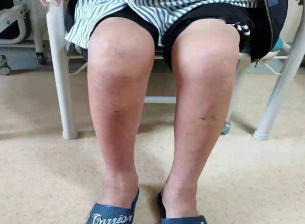 广东|每天喝十几瓶啤酒，广东一男子体内抽出“牛奶”