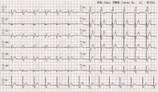 心电图库丨完全性右束支阻滞系列_窦性_心律_avr