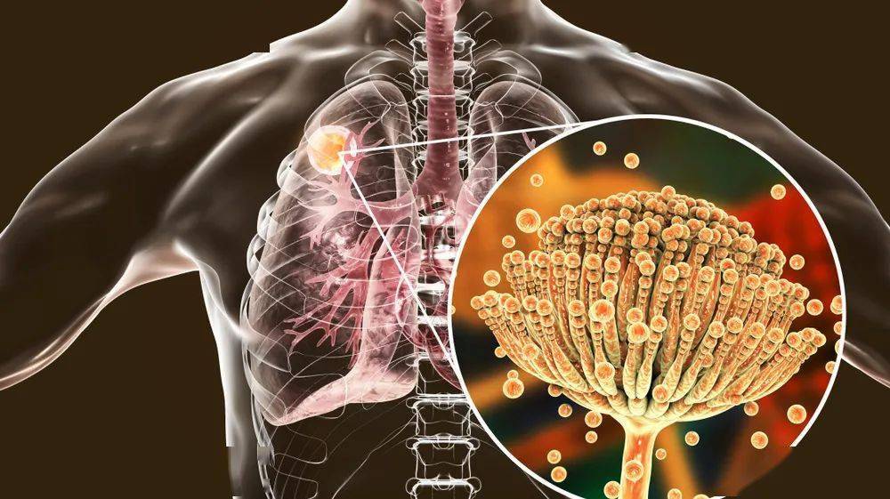 有 2 件事越早知道越好_黄曲霉_人体_孢子