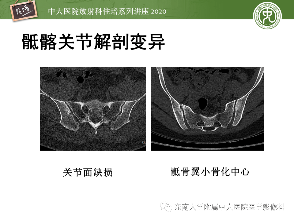 常见骶髂关节病变的影像表现