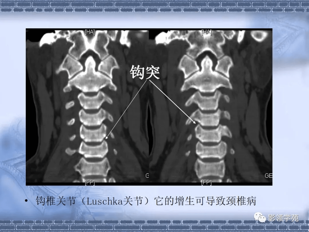 怎么看颈椎病ct片 9c0942f09444440d888a983c9fc78321.png