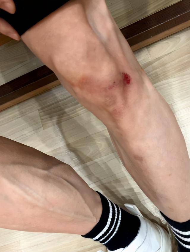 张一山与关晓彤打篮球摔伤膝盖磨破流血不止仍坚持将戏拍完