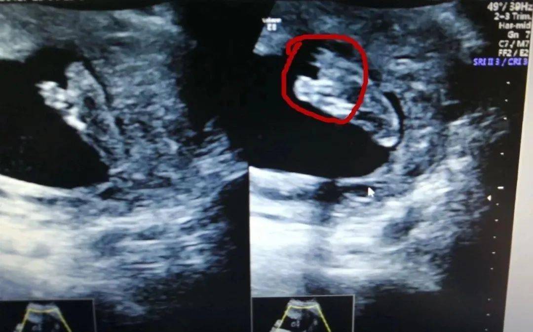 胎儿足内翻 四维图片