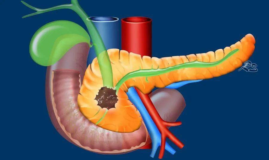 胰颈癌图片
