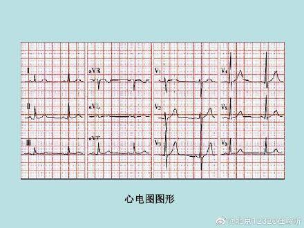 看看是不是整齐的,如果不整齐,就表示心率不齐,可能存在心律失常,最