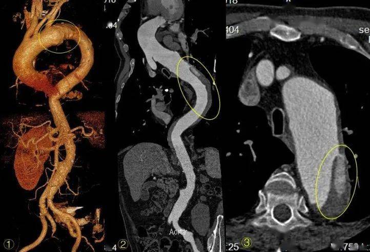 主动脉壁间血肿不在意小心图穷匕见