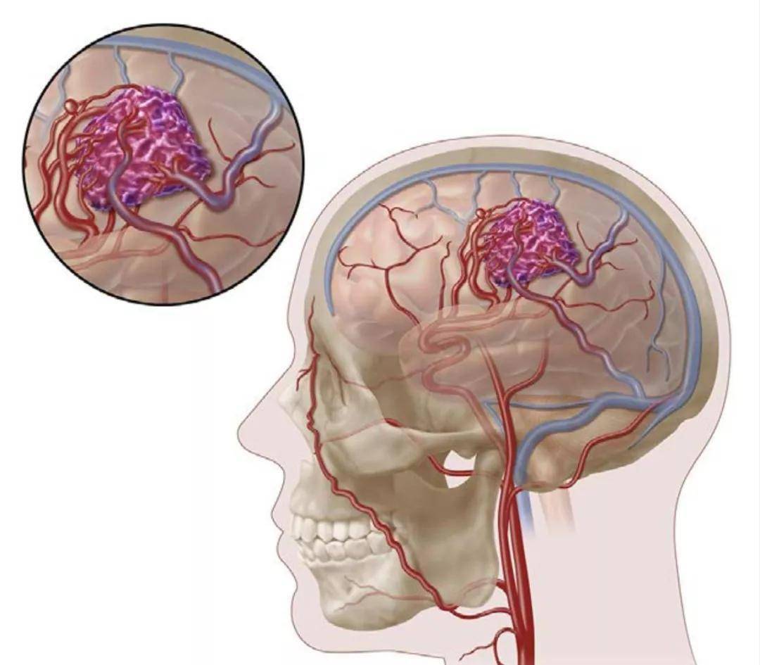 先天性脑血管畸形图片图片