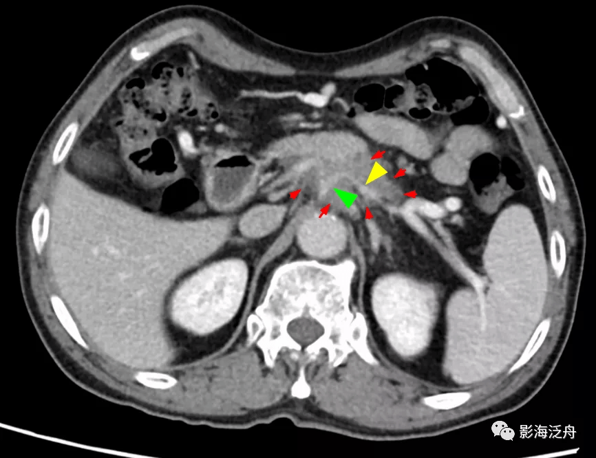 静脉|影像阅片，千万不能“掐头去尾”
