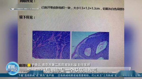 汪乐萍|男子脸上痣突然增大，一查竟是癌！这些部位有痣的人要注意！