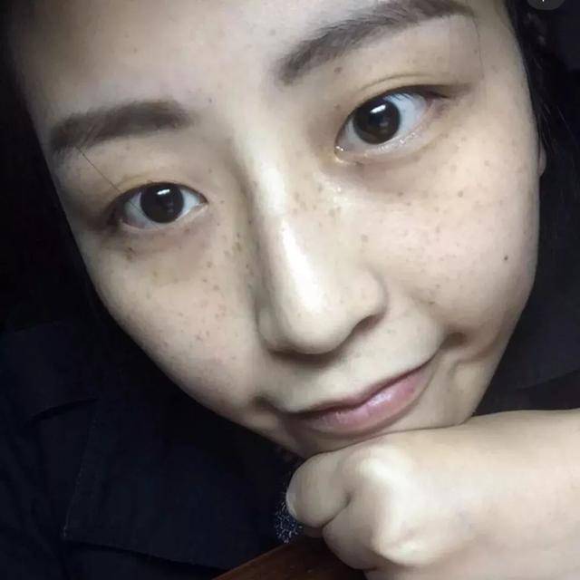 35岁湖南张女士,长期靠维生素e来淡斑,现在皮肤咋样了?