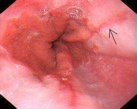 巴雷特食管症状图片图片