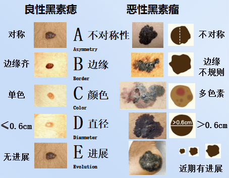 身上有这种痣的一定要注意专家教你几招自测危险程度赶紧看看