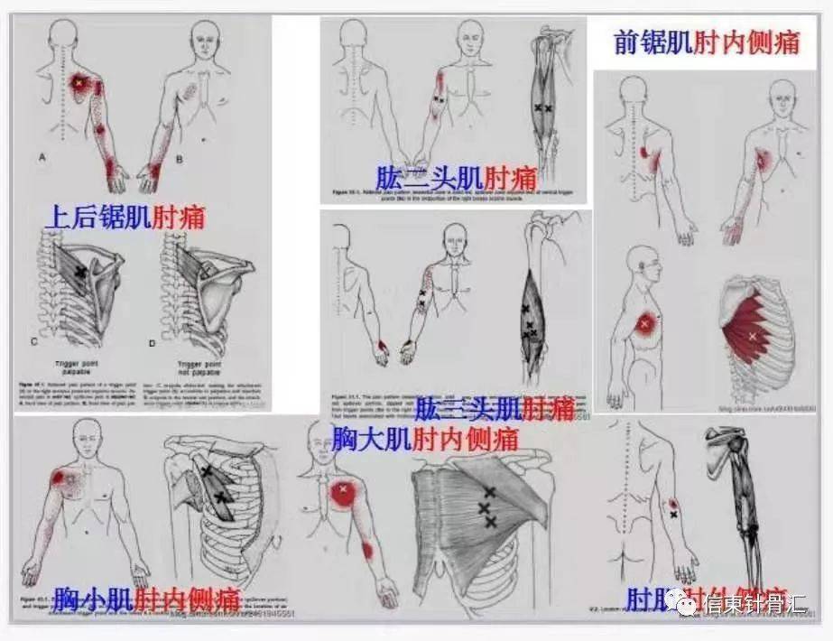 肌筋膜全身160个疼痛触发点